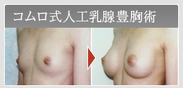 コムロ式人工乳腺豊胸術