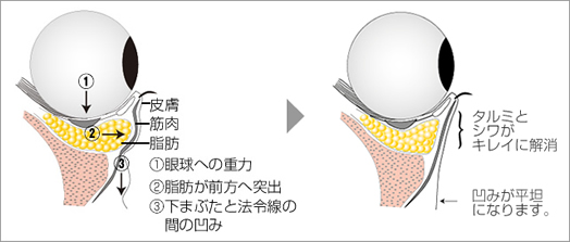 下眼瞼脱脂の説明図