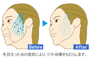 リフト効果イメージ