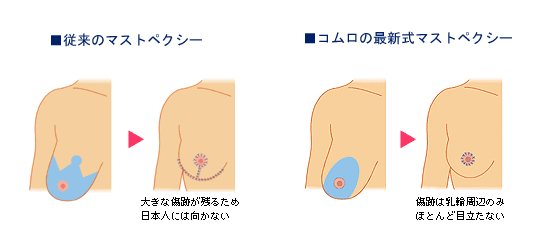 従来のマストペクシーとの比較