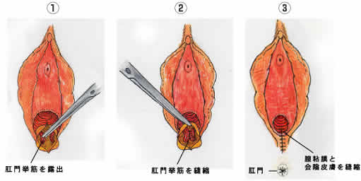 施術方法1