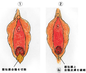 施術方法2