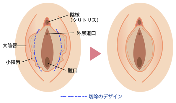 小陰唇縮小術（リッペ）とは