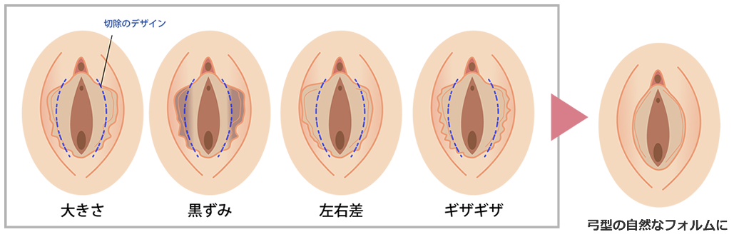 小陰唇４大お悩み