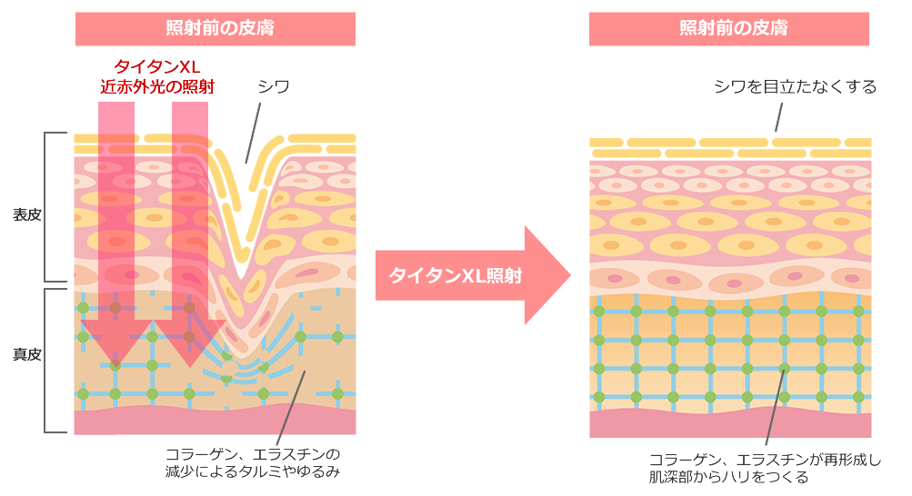 照射前の皮膚と照射後の皮膚