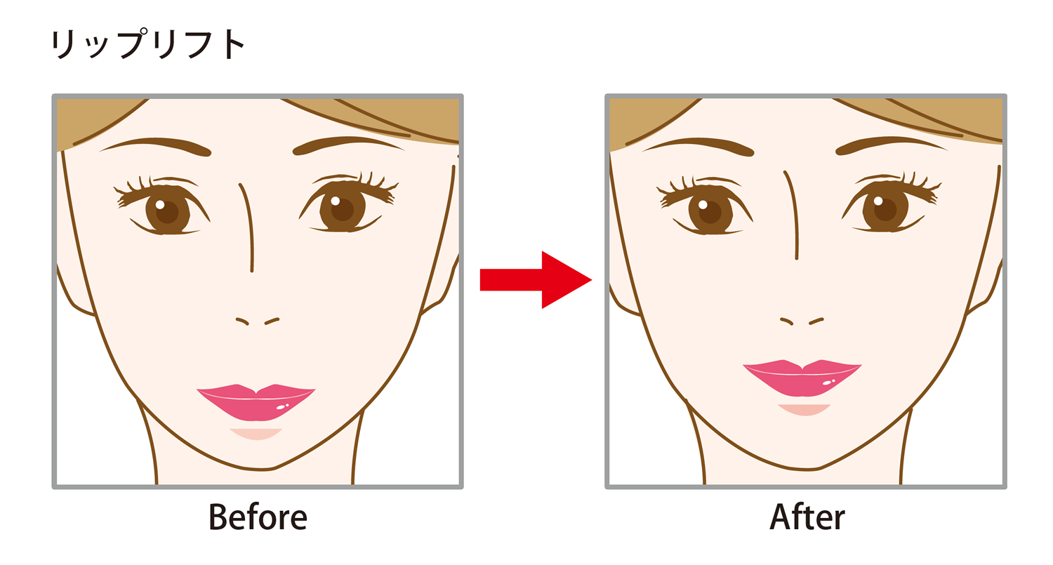 【大人気！鼻の下が長くてお悩みの方へ】リップリフト（人中短縮）で間延びした老け顔を解消！