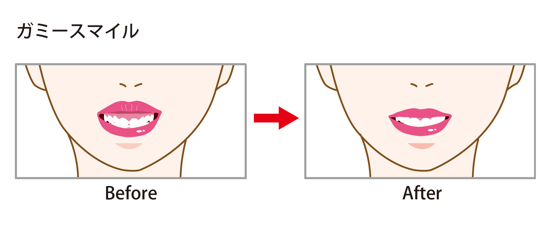 笑った時口元を手で隠したくない方必見！笑うと歯茎が見えるガミースマイル最新治療