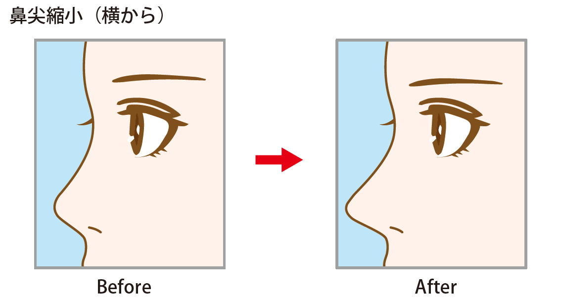 「鼻尖縮小」 ～手軽に、鼻先を形よく整えるなら～